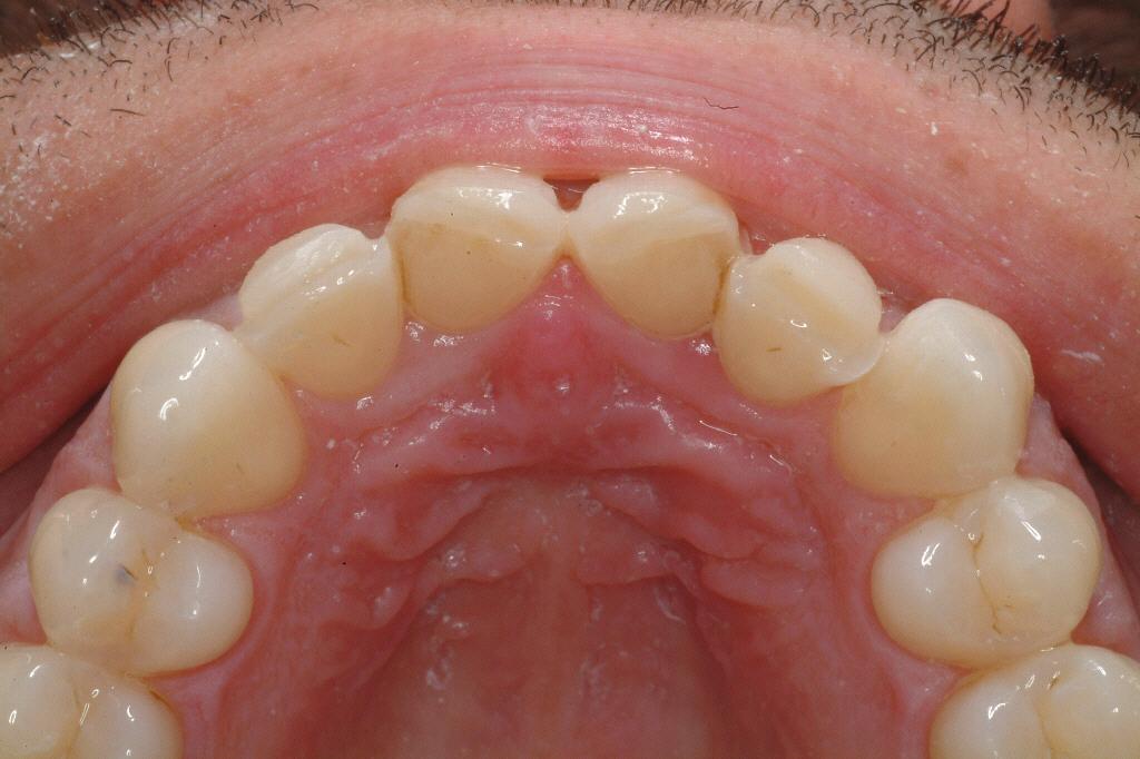 The teeth were prepared as minimally as possible, except for the removal of the old composite restorations (Figure 2), utilizing a diamond bur (ie, #5856-016, Brasseler USA, Savannah, GA) for gross