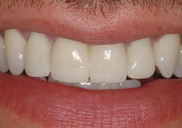 5 mm) of tooth structure needed to achieve the desired results, significant enamel was conserved.