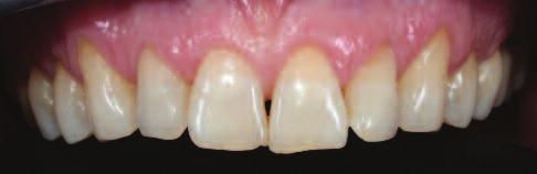 proving the clinical feasibility, is to simulate the aesthetic outcome directly in the mouth.