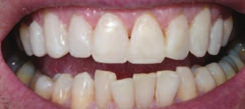 In this case, establishing the anterior guidance was not essential at this stage, because in a second step, the arch in the lower jaw was to be harmonised by orthodontic treatment and then veneered.