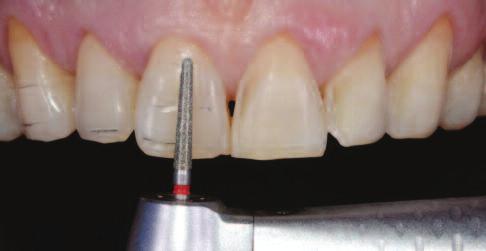 The shorter premolars were provided with two horizontal cuts for the same procedure (Figure 9). The incisal edges were reduced with two vertical cuts of at least 1.