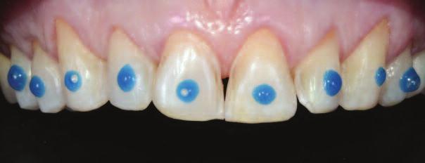 Figure 14: Honigum Pro impression note high definition detail reproduction Figure 15: Spot etching with phosphoric acid gel extended evenly along the buccal surfaces from the incisal areas to the