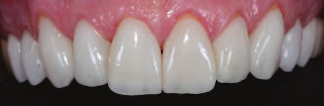 Figure 16: Temporaries after Luxatemp Glaze has been applied Figure 17: Veneers in situ using the appropriate shade of Vitique try-in paste Figure 18: Acid etching the teeth prior to permanent