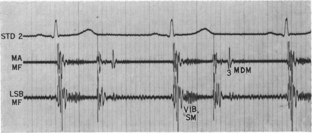Innocent murtmurs and third heart sounds a third heart sound in some apparently normal young subjects (Fig. 2) with no supportive evidence of organic heart disease.