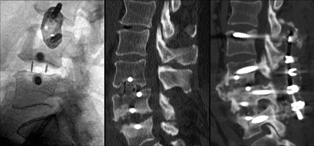 J.E. Brier-Jones et al. / The Spine Journal 11 (2011) 1068 1072 1069 X-ray absorptiometry scan to assess for osteoporosis. The patient presented with low back pain and bilateral leg pain.
