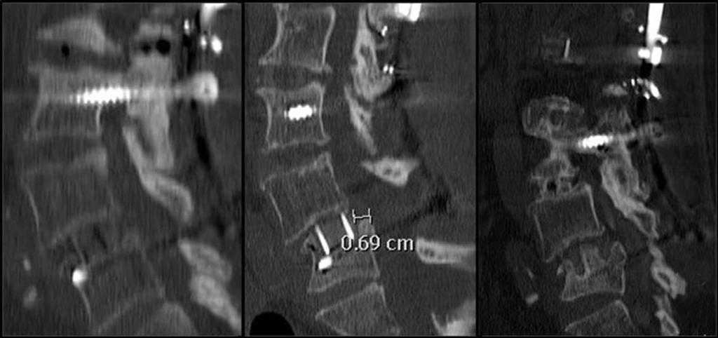 postoperative lateral radiograph, and (D) computed tomography scans showing the L5 coronal plane fracture initially and (E) 15 months postoperatively. with no history of significant trauma (Fig.