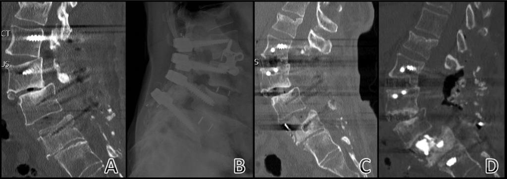 J.E. Brier-Jones et al. / The Spine Journal 11 (2011) 1068 1072 1071 (Fig. 4A). Pseudarthrosis, as evidenced by posterior hardware lucency, and gross movement developed after the surgery.