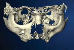 routine implant treatment has improved and implant prosthodontics has