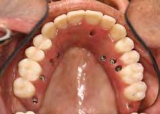 A total of four Brånemark System Zygoma implants were installed two in each zygoma.