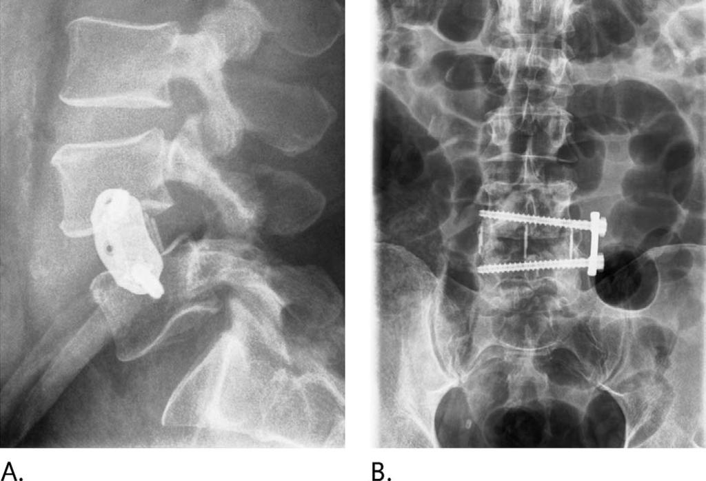 Tender, GC Figure 3. Lateral (A) and anteroposterior (B) intraoperative x-rays of the L4-L5 extreme lateral interbody fusion construct supplemented with a lateral plate.