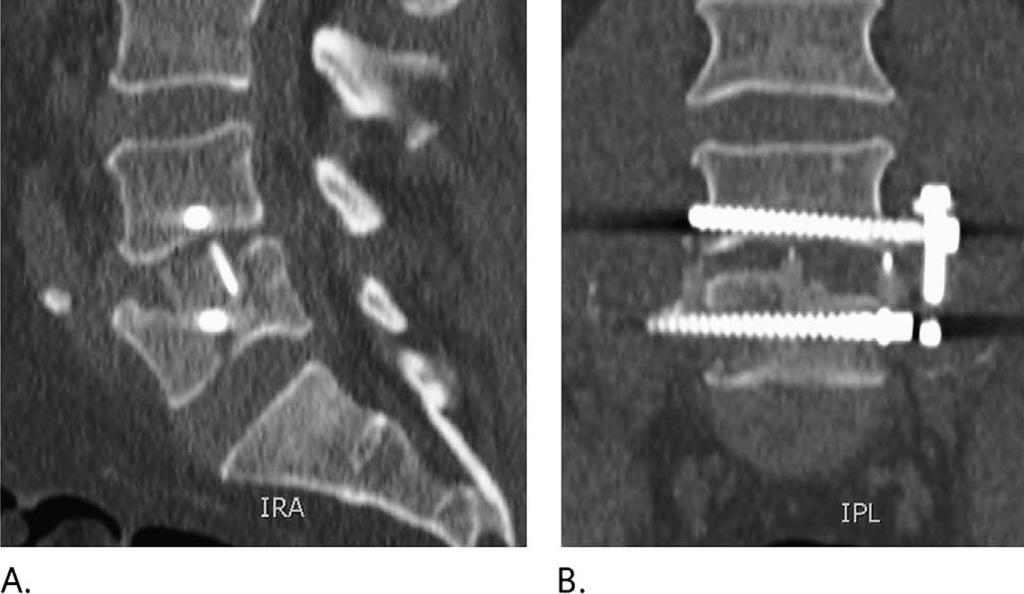 Vertebral Body Fractures Following Lateral Interbody Fusion Figure 5.
