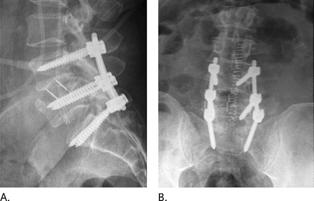 In the first patient, the placement of the interbody cage was perfectly parallel to the endplates and the screws for the lateral plate were close to the adjacent endplates, as recommended.