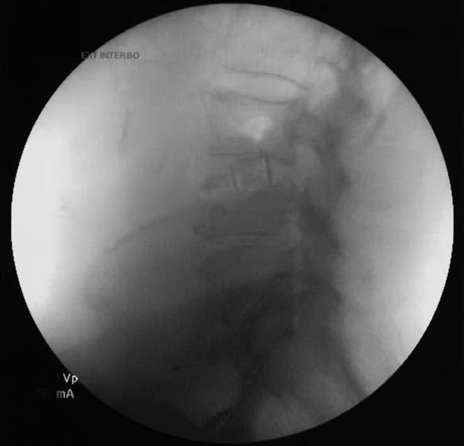 Vertebral Body Fractures Following Lateral Interbody Fusion Figure 9.