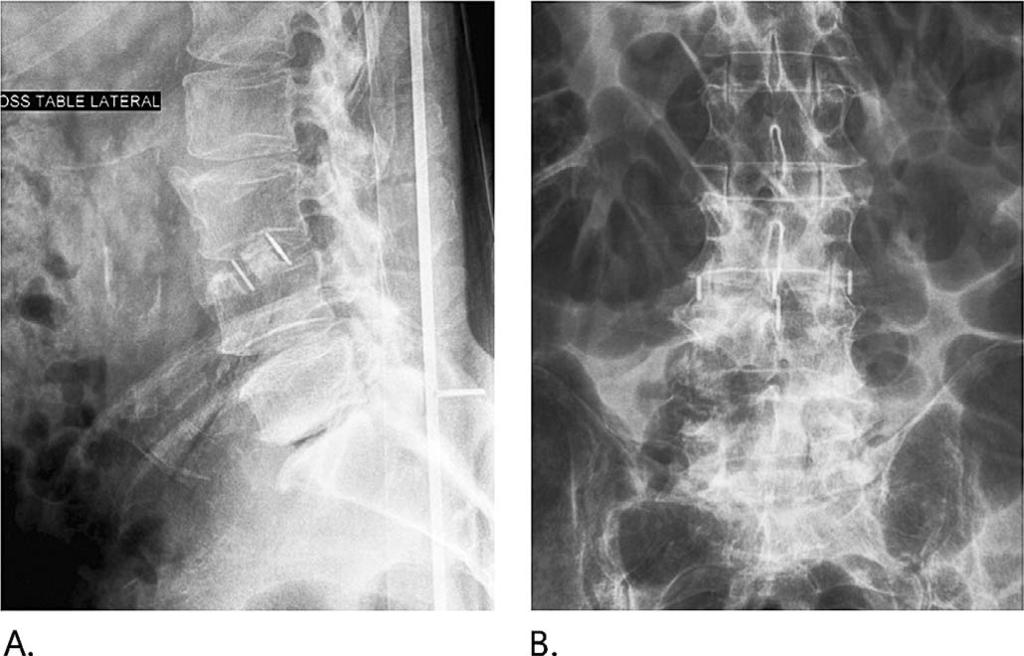 Tender, GC Figure 11. Lateral (A) and anteroposterior (B) postoperative x-rays showing the slightly oblique position of the cage in the L3-L4 interspace with indentation of the L4 endplate.