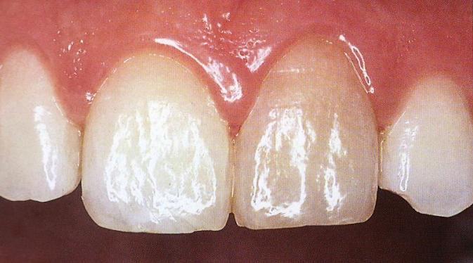 Nekroza pulpe nastaje kao posljedica bakterijske, mehaničke ili kemijske iritacije pri čemu dolazi do oslobađanja produkata razgradnje tkiva i infiltracije istih u dentinske tubuluse.