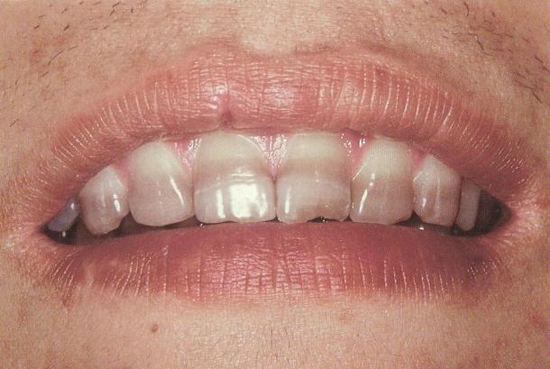 JATROGENI UZROCI Tetraciklinska obojenja nastaju zbog sistemske primjene antibiotika širokog spektratetraciklina tijekom mineralizacije zuba (slika 1).
