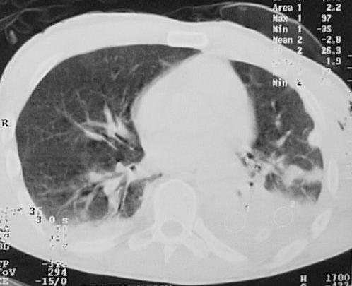 impossibility to reach an accurate diagnosis through chest X-ray or computed tomography, the severe clinical course of these polytrauma patients claiming a therapeutic decision.
