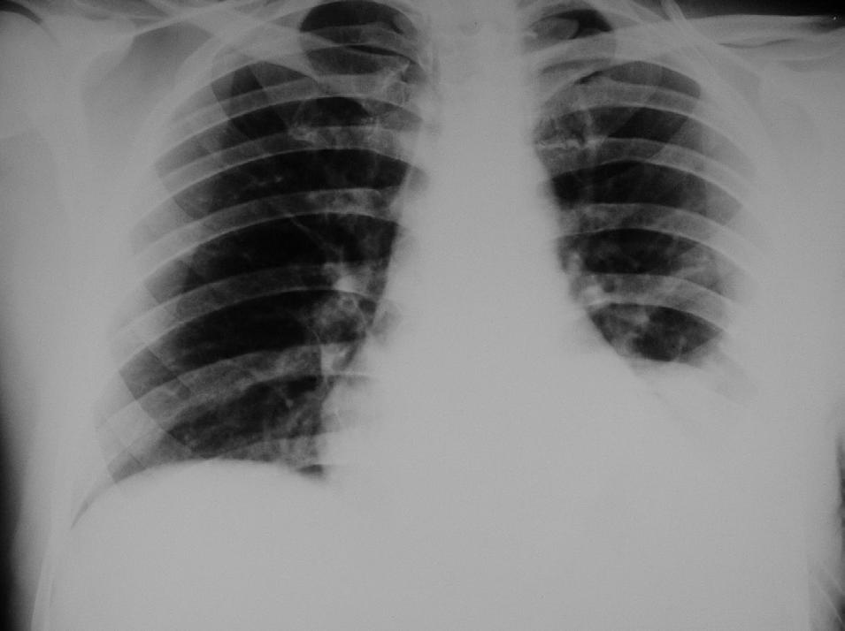 in one case and through thoracentesis, clinical and radiological evolution in the other case.
