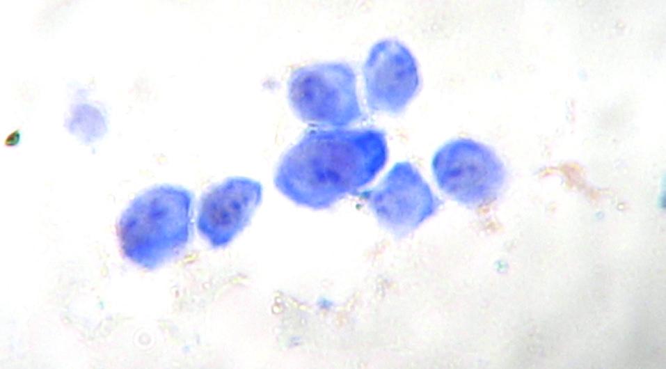 Cytological aspects of the specimens get at FNA in contused lung vary with place and stage of the contusion.