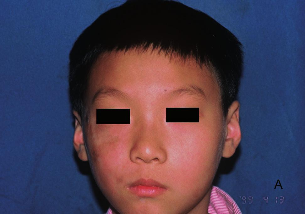 INTRODUCTION Parry-Romberg syndrome (PRS) is a rare disorder.