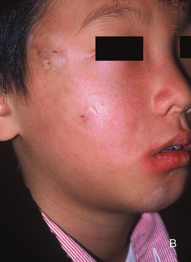 1 We describe a case of PRS in a patient who subsequently presented with systemic lupus erythematosus (SLE). A review of the literature demonstrates the rare coexistence of these two disorders.