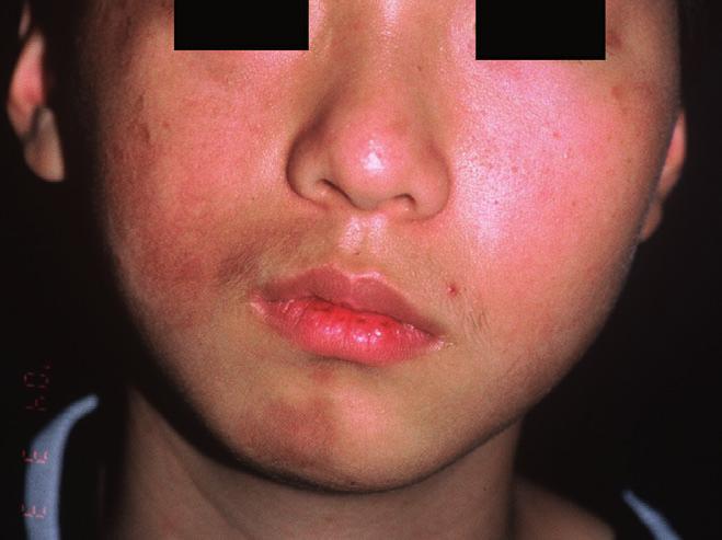 According to the dermatologist s followup, right sided hemifacial atrophy became more obvious as the patient grew.