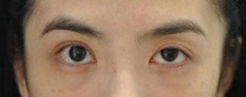 166 Subclinical Ptosis Correction: Incision, Partial Incision, and Nonincision: The Formation of the Double Fold Kim et al.