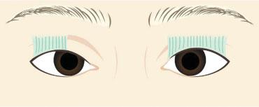 Subclinical Ptosis Correction: Incision, Partial Incision, and Nonincision: The Formation of the Double Fold Kim et al.