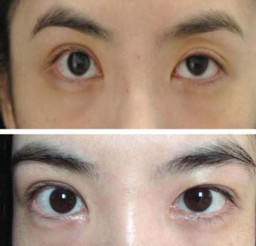 168 Subclinical Ptosis Correction: Incision, Partial Incision, and Nonincision: The Formation of the Double Fold Kim et al. Fig.