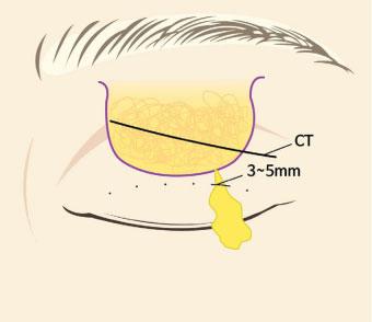 Subclinical Ptosis Correction: Incision, Partial Incision, and Nonincision: The Formation of the Double Fold Kim et al.
