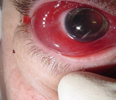 Chemical injury Chemical injury to the eyes may sometimes be very severe, causing a penetrating eye injury.