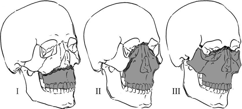 fractures. Sometimes, Le Fort fractures cause the mid face to move in comparison with the rest of the face or the skull (42).