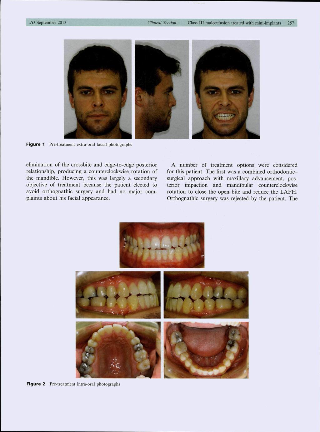 JO September 2013 Clinical Section Class III malocclusion treated with mini-implants 257 Figure 1 Pre-treatment extra-oral facial photographs elimination of the crossbite and edge-to-edge posterior