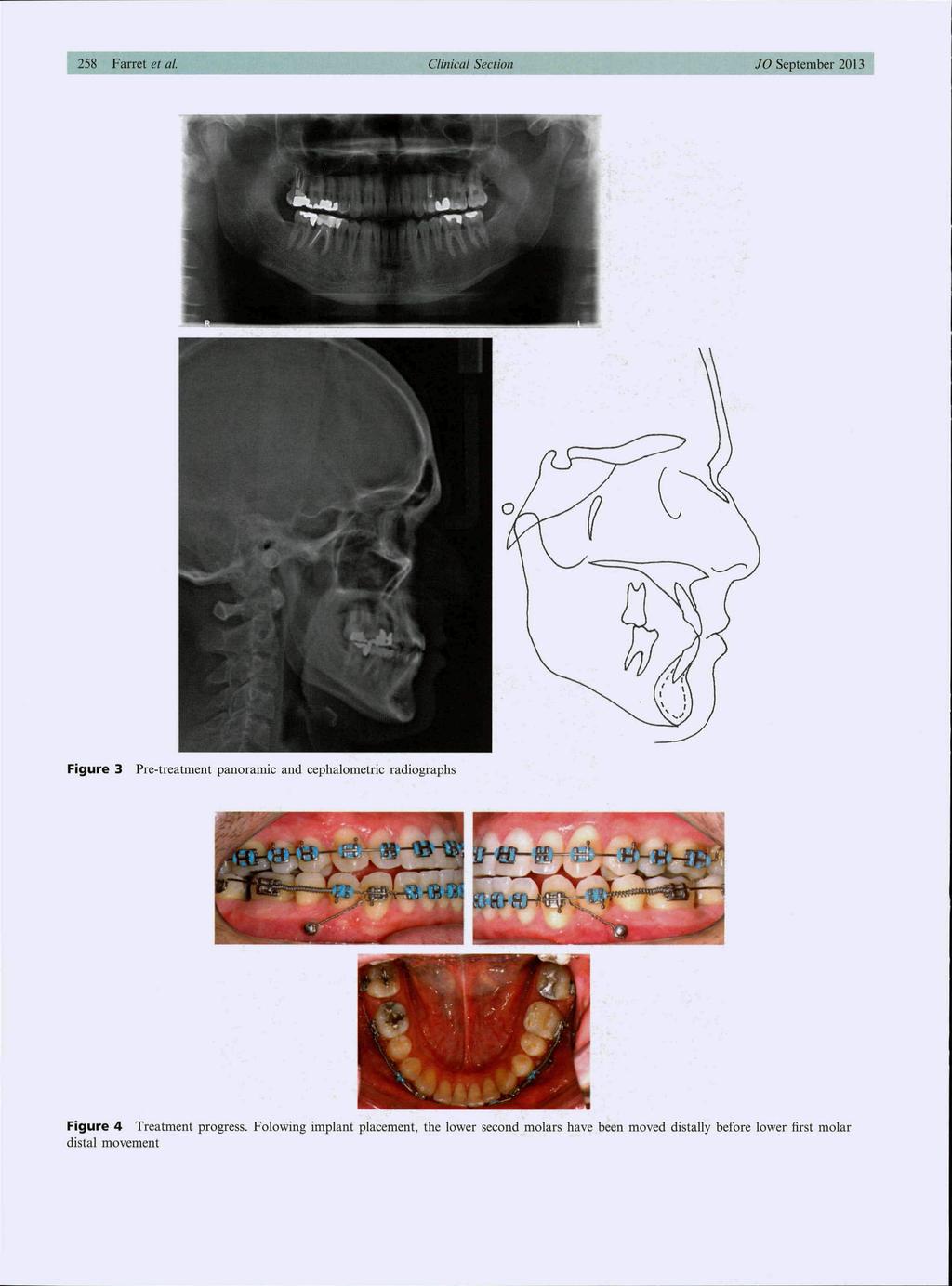 7O September 2013 Figure 3 Pre-treatment panoramic and cephalometric radiographs Figure 4 Treatment progress.