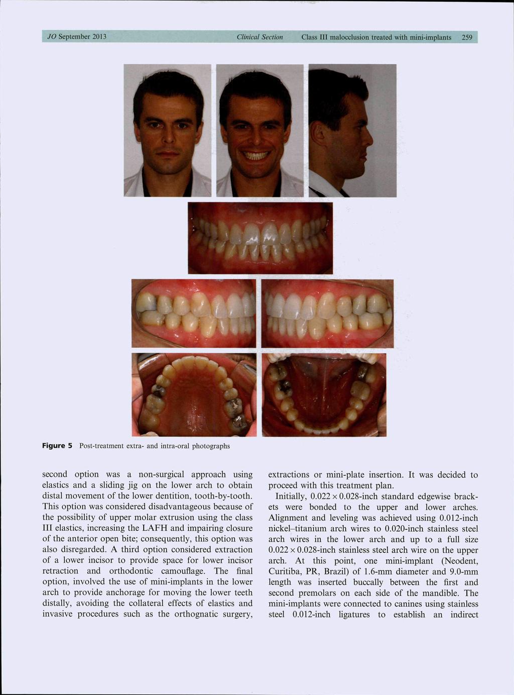 JO September 2013 Clinical Section Class III malocclusion treated with mini-implants 2591 L J Figure 5 Post-treatment extra- and intra-oral photographs second option was a non-surgical approach using