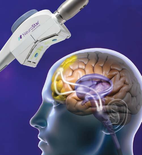 EXAMPLES OF TMS DEVICES NeuroStar (Neuronetics, Inc.).