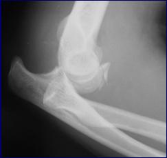 Radial Head Primary restrain to axial load on the radius Primary restrain to valgus strain on the elbow joint.