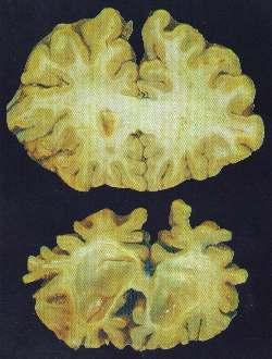 Center HUGE CHANGES used with permission from The Broken Brain: Alzheimers, 1999 University of Alabama ExecuMve Control