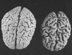 Brain atrophy the brain actually shrinks cells wither then die abilities are lost with