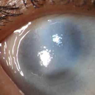 Figure 5: Bilateral Sclerocornea: left eye after Penetrating keratoplasty showing a clear graft at 8 months follow-up Figure 4: Sclerocornea: Note the diffuse opacity which is centrally dense
