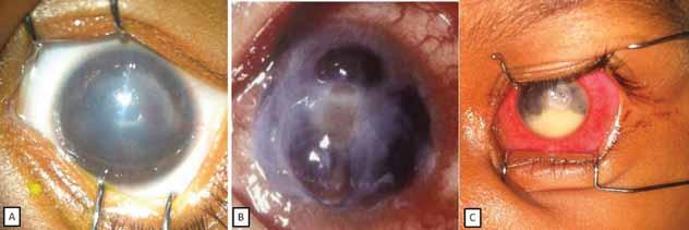 This leads to high residual corneal agtigmatism requiring urgent correction to prevent amblyopia.