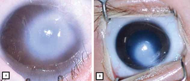 Figure 10: Peter s anamoly Figure 11: such a condition among the ophthalmologists and cornea surgeons.