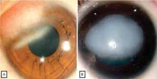 Slit lamp examination reveals a 2-3 times thick corneal which prevents a clear view of the anterior segment which is usually normal. CHED 2 patients might also present with nystagmus (Figure 12 A,B).