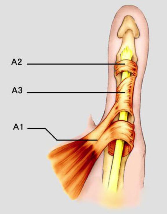 TRIGGER DIGITS Definition: This problem generally is caused by a size mismatch between the flexor tendon and the first annular (A-1) pulley.
