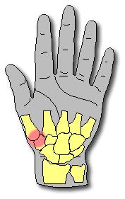 Arthritis basal thumb