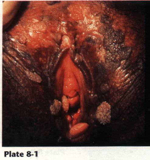 Genital Warts From