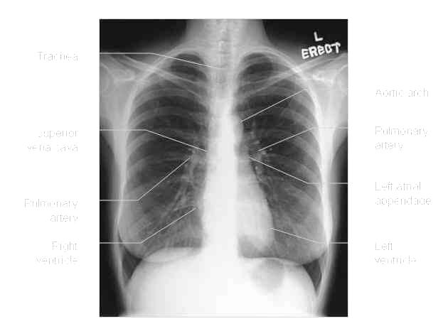 Increasing prevalence of drugresistant TB 1994-1997 Patients without