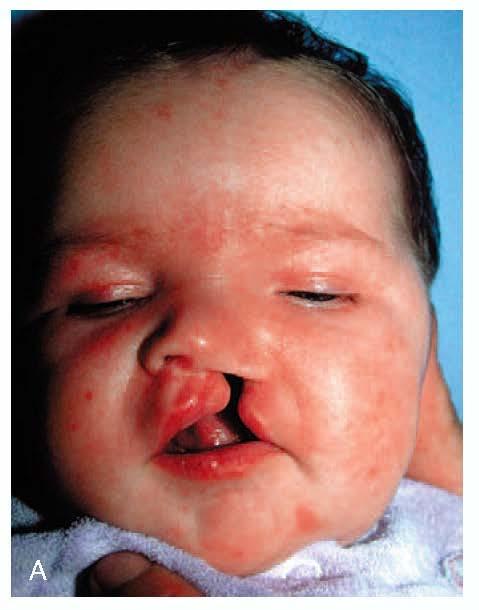 Infant with a Left Unilateral Complete Cleft Lip and Palate From Kaban L, Troulis M: Pediatric oral and