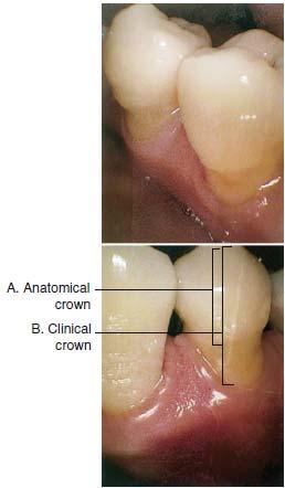 Anatomical and Clinical Crowns 44 Copyright