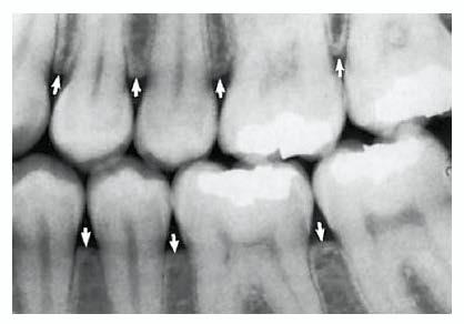The Alveolar Crest From Haring JI, Lind LJ: Radiographic interpretation for the dental